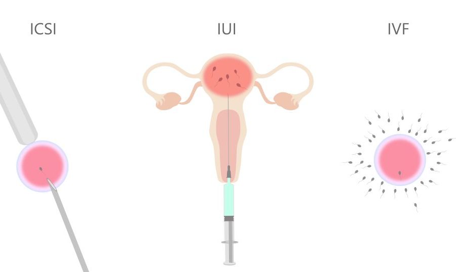 IUI, IVF และ ICSI คือเทคโนโลยีช่วยการเจริญพันธุ์ ช่วยเพิ่มโอกาสมีบุตรสำหรับผู้มีภาวะมีบุตรยาก